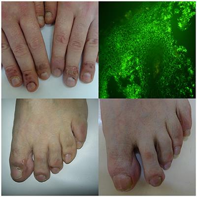 Involvement of Nail Apparatus in Pemphigus Vulgaris in Ethnic Poles Is Infrequent